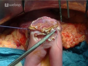 Antecolische End-zu-Seit-Duodeno-Jejunostomie