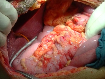 Lavage und Drainagen-Anlage