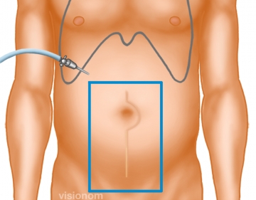 Anlegen des Pneumoperitoneums, Inspektion der Bauchhöhle