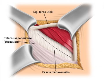 Spaltung der Externus-Aponeurose und Anschlingung des Lig. teres uteri
