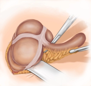 Skelettierung der Appendix