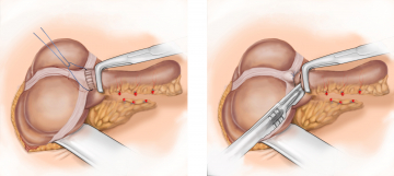 Ligatur und Abtragung der Appendixbasis