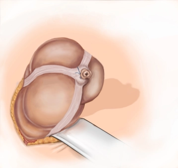 Versenkung des Stumpfes