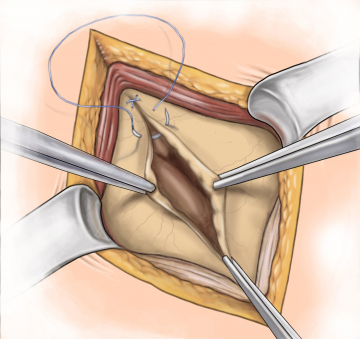 Peritoneal- und Fasziennaht