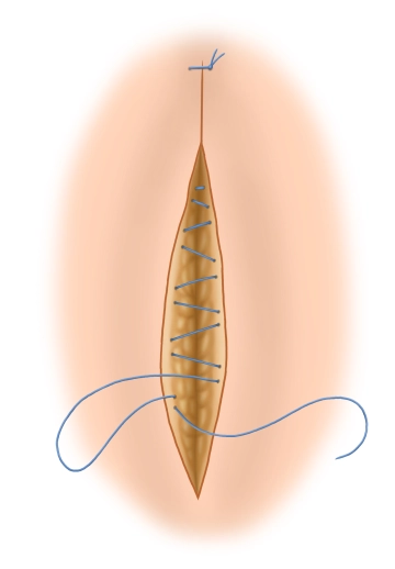 Beenden der Operation