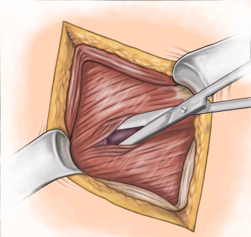 Spaltung der Muskulatur