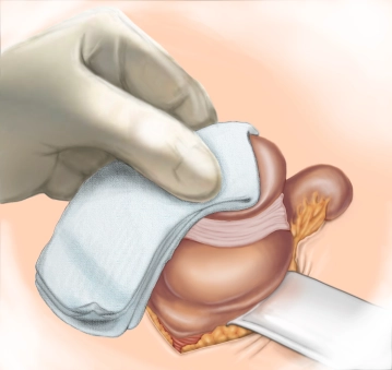 Luxation des Zökalpols