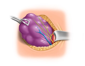 Darstellung, Anzügeln und Neuromonitoring des Nervus vagus