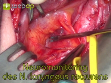 Darstellung und Neuromonitoring des N. laryngeus recurrens