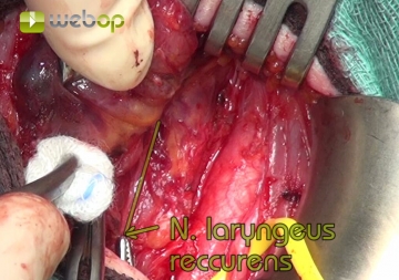 Verfolgen des N. laryngeus recurrens bis zum Kehlkopf