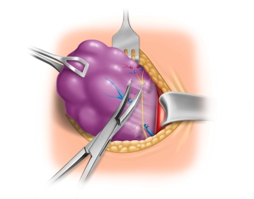 Darstellung der oberen Nebenschilddrüse