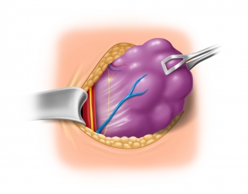 Darstellen und Neuromonitoring des N. vagus