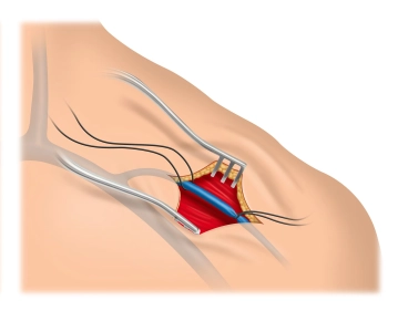 Präparation der V. cephalica im Sulcus deltoideopectoralis