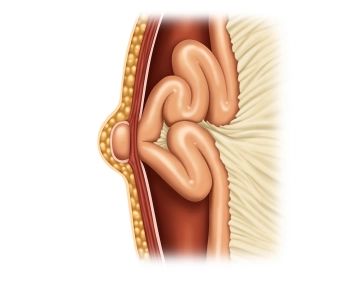Anatomisch-klinische Aspekte des Verschlusses von Trokarinzisionen