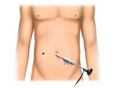 Anlegen des Pneumoperitoneums und Inspektion der Abdominalhöhle