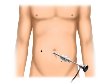 Anlegen des Pneumoperitoneums und Inspektion der Abdominalhöhle