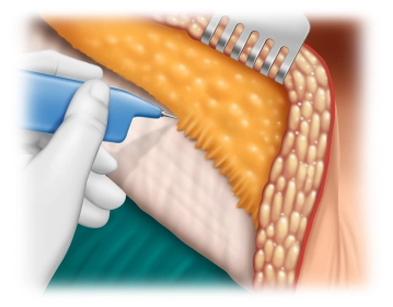 Ablösen der Subkutis