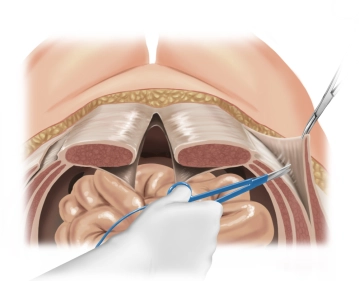 Separation des Muskulus obliquus externus