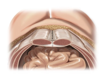 Verschluss des vorderen Blatts der Rektusscheide