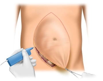 Hautschnitt; Exzision der Narbe
