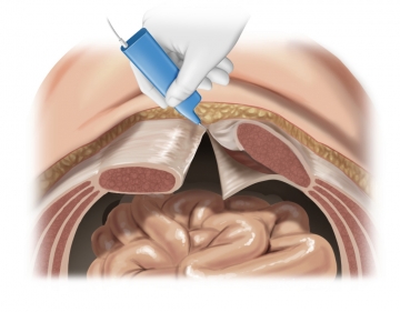 Ablösen hintere Rektusscheide/Peritoneum