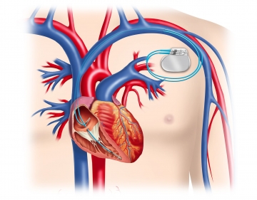 Anatomie Herzschrittmacherimplantation Zweikammersystem