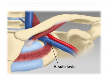 Punktion der V. subclavia in Seldingertechnik