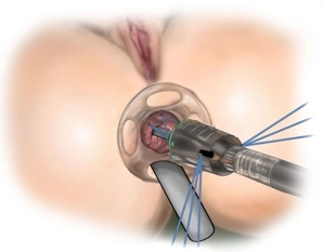 Einbringen des Staplers