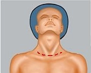 Prophylaxe und Management intraoperativer Komplikationen