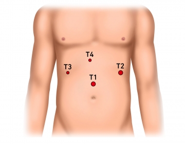 Anlegen des Pneumoperitoneums, Einbringen des Optiktrokars und Exploration des Oberbauchs