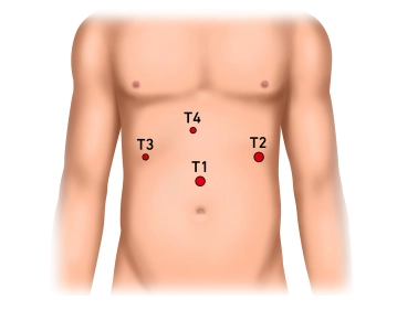 Anlegen des Pneumoperitoneums, Einbringen des Optiktrokars und Exploration des Oberbauchs