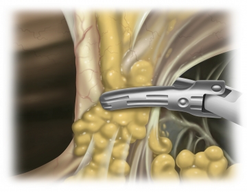 Einbringen der ersten Arbeitstrokare und Absetzen des Lig. teres hepatis und des Lig. falciforme