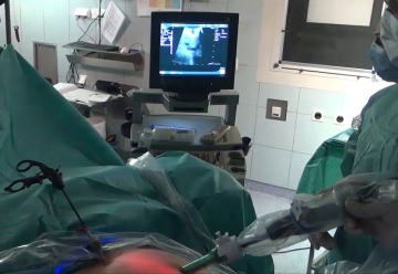 Lokale Befunderhebung: Intraoperative Sonographie (IOUS)