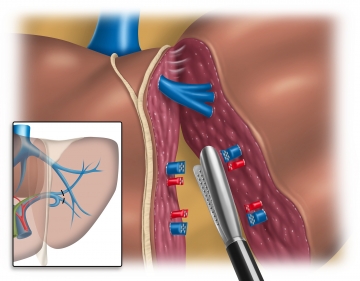 Beginn der Parenchymdissektion; Absetzen der Pfortaderversorgung und der Arterie