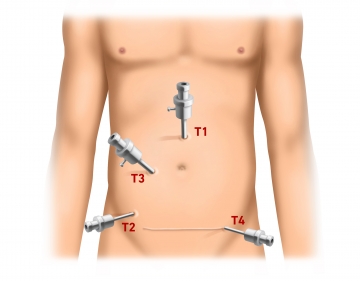 Anlegen des Pneumoperitoneums und Trokarpositionierung