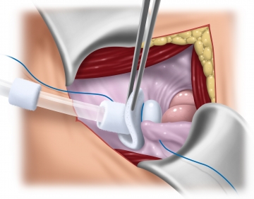 Platzieren des Dialysekatheters und Peritonealverschluss