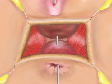 Präparation des Spatium rectovaginale; Darstellen des Sphinkter externus und M. puborektalis