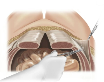 Bauchwandmobilisation I: Anteriore Komponentenseparation