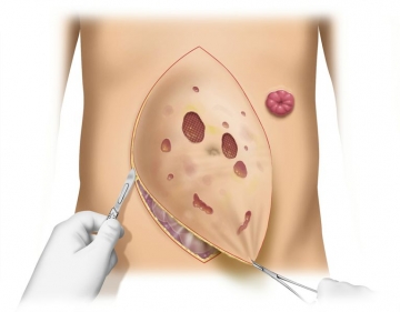 Präparation des Bruchsacks und Darstellung der Bruchlücke