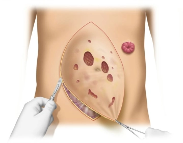 Präparation des Bruchsacks und Darstellung der Bruchlücke