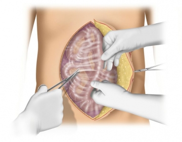 Intraabdominelle Adhäsiolyse