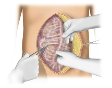 Intraabdominelle Adhäsiolyse