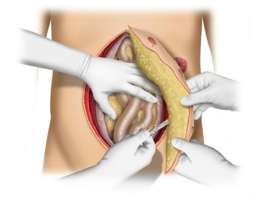 Komplettierung der Exzision von Haut und Bruchsack