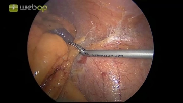 Mobilisation des Colon descendens von lateral