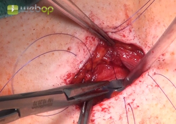 Die transkutane Fixierung der Fensterflügel