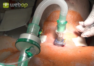 Die äußere Fixierung