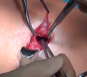 Präparation des präperitonealen Raums