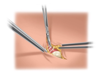 Präparation des Bruchsacks