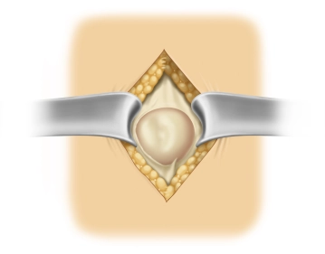 Zirkuläres Darstellen der Faszienränder