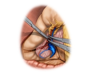 Ablösung des großen Netzes; Absetzen der gastroepiploischen Gefäße